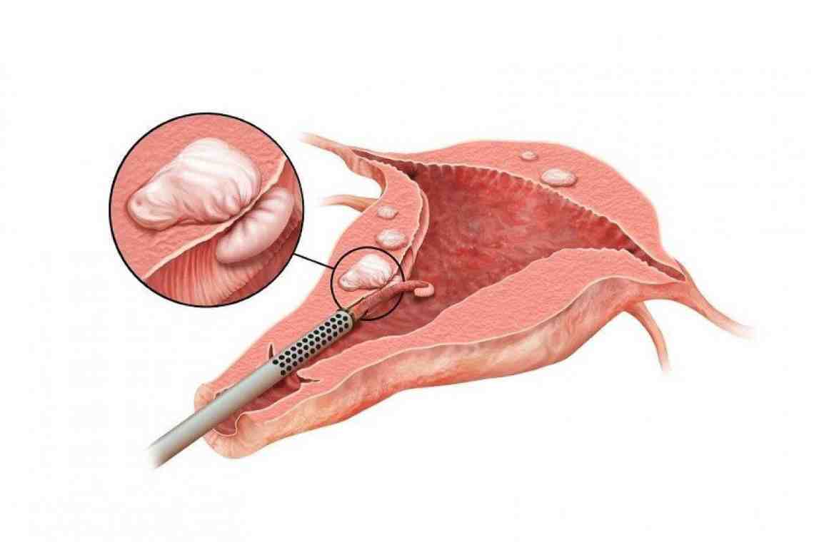 Субмукозная миома гистероскопия