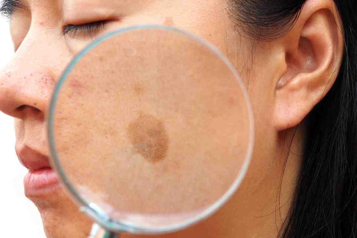 Меланоз кожи: причины, симптомы и лечение