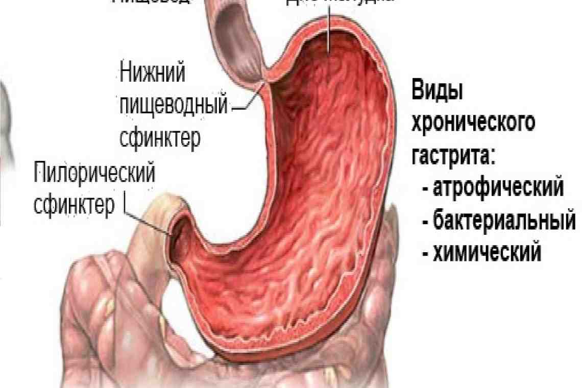 Воспаление желудка (гастрит): симптомы и лечение, диета