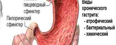 Воспаление желудка (гастрит): симптомы и лечение, диета