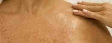 Солнечный кератоз кожи: симптомы, причины и особенности лечения