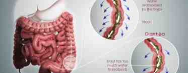 СРК с диареей: как лечить синдром раздраженного кишечника с поносом