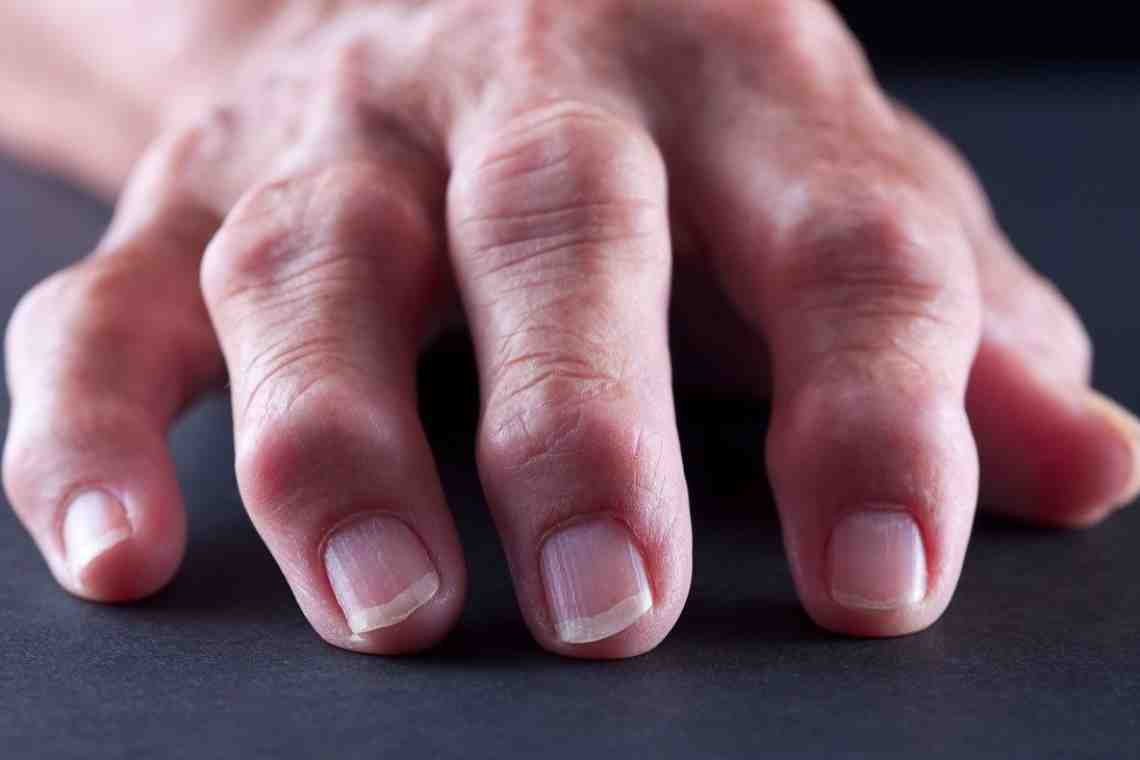 Почему отекают пальцы на руках: причины, возможные заболевания, лечение