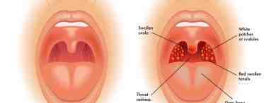 Шишка в горле: причины появления, описание и особенности лечения