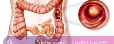 Синдром раздраженного кишечника: причины, симптомы, ранняя диагностика, методы лечения, профилактика