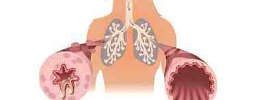 Бронхиальная астма: стадии, симптомы, диагностика и методы лечения