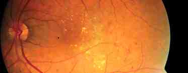 Диабетическая ретинопатия: симптомы, лечение, диагностика