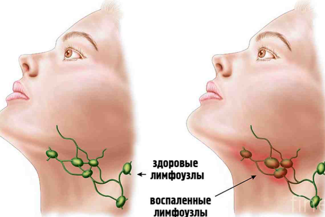 Лимфоаденопатия узлов под челюстью