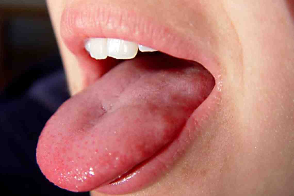Шершавый язык: причины, возможные заболевания, методы лечения и отзывы