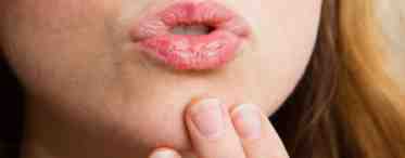 Почему губы сохнут и шелушатся? Причины, методы лечения