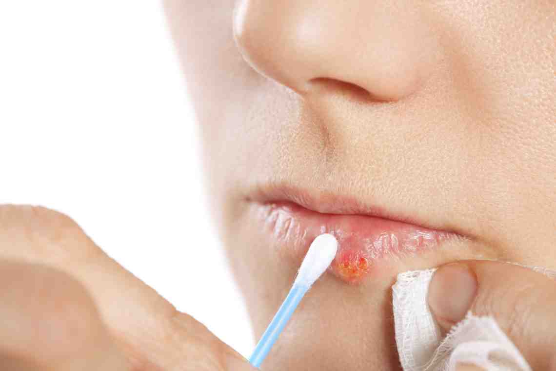 Герпес на губах: лечение в домашних условиях. Как быстро вылечить герпес на губах в домашних условиях?