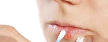 Герпес на губах: лечение в домашних условиях. Как быстро вылечить герпес на губах в домашних условиях?