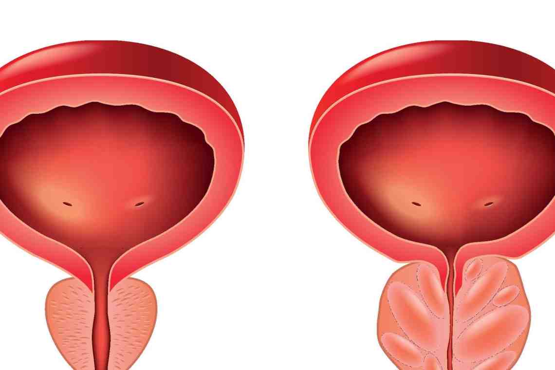 Воспаление предстательной железы, симптомы, лечение и профилактика
