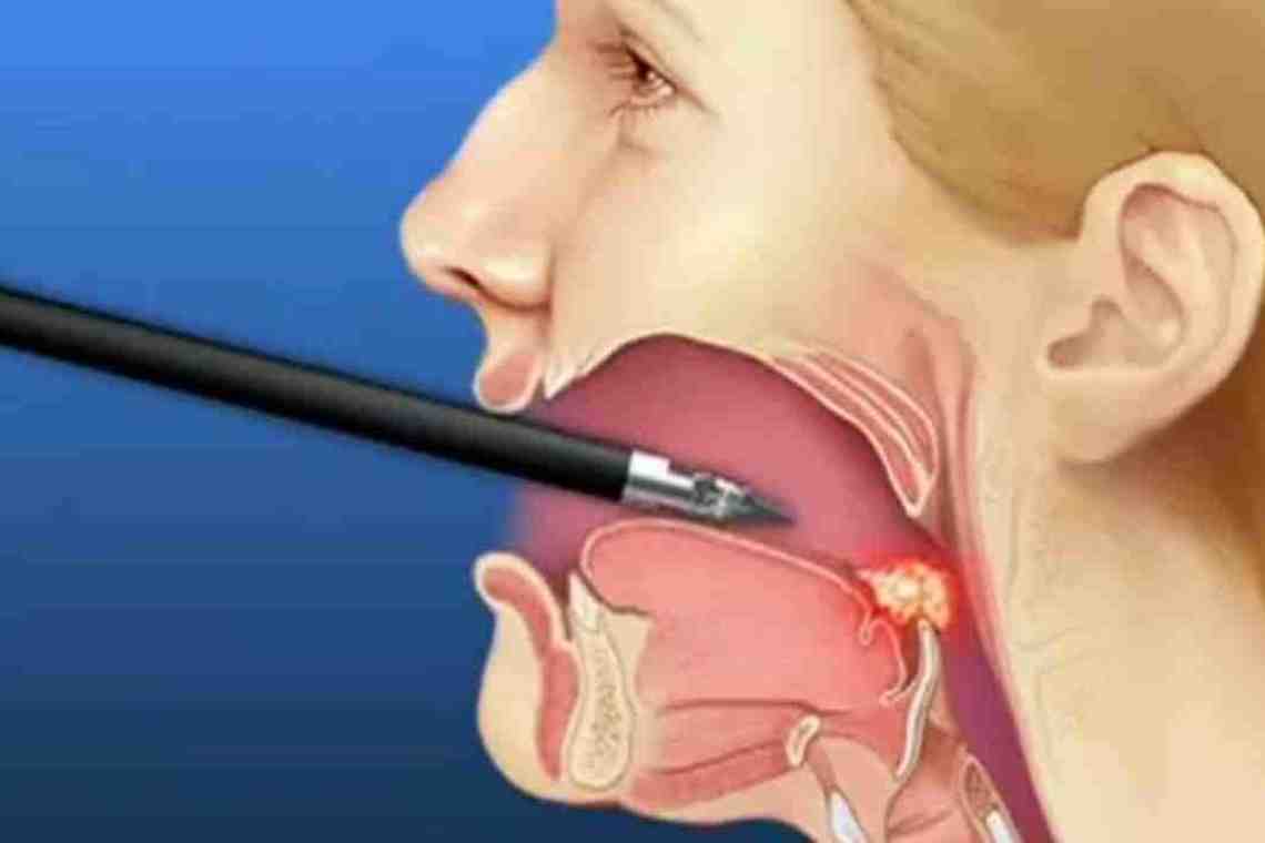 Заглоточный абсцесс: причины, симптомы, диагностика и методы лечения