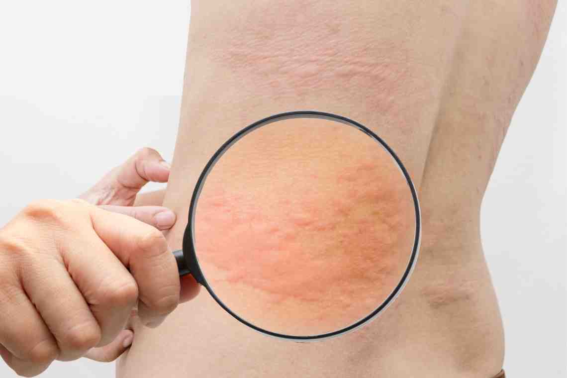 Сыпь на коже: симптомы и лечение