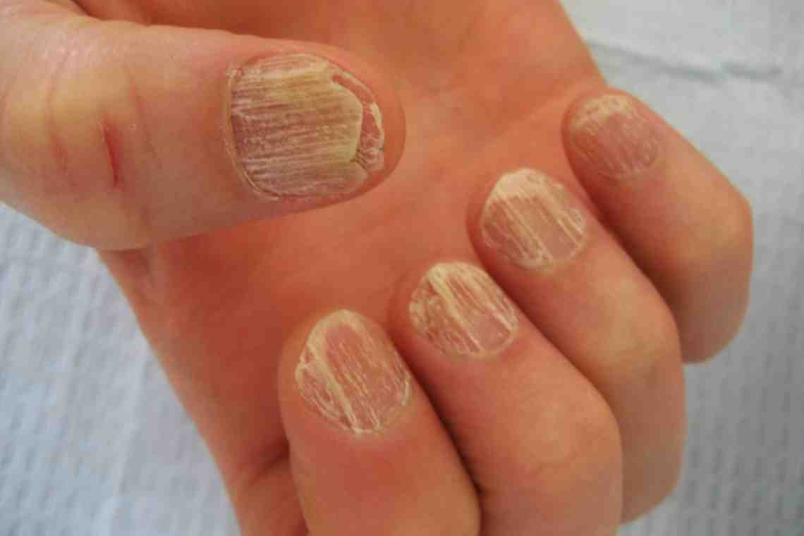 Микозы ногтей: как избежать и чем лечить