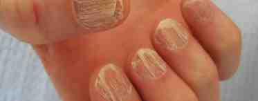 Микозы ногтей: как избежать и чем лечить