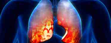 Пневмония интерстициальная: причины, лечение, осложнения