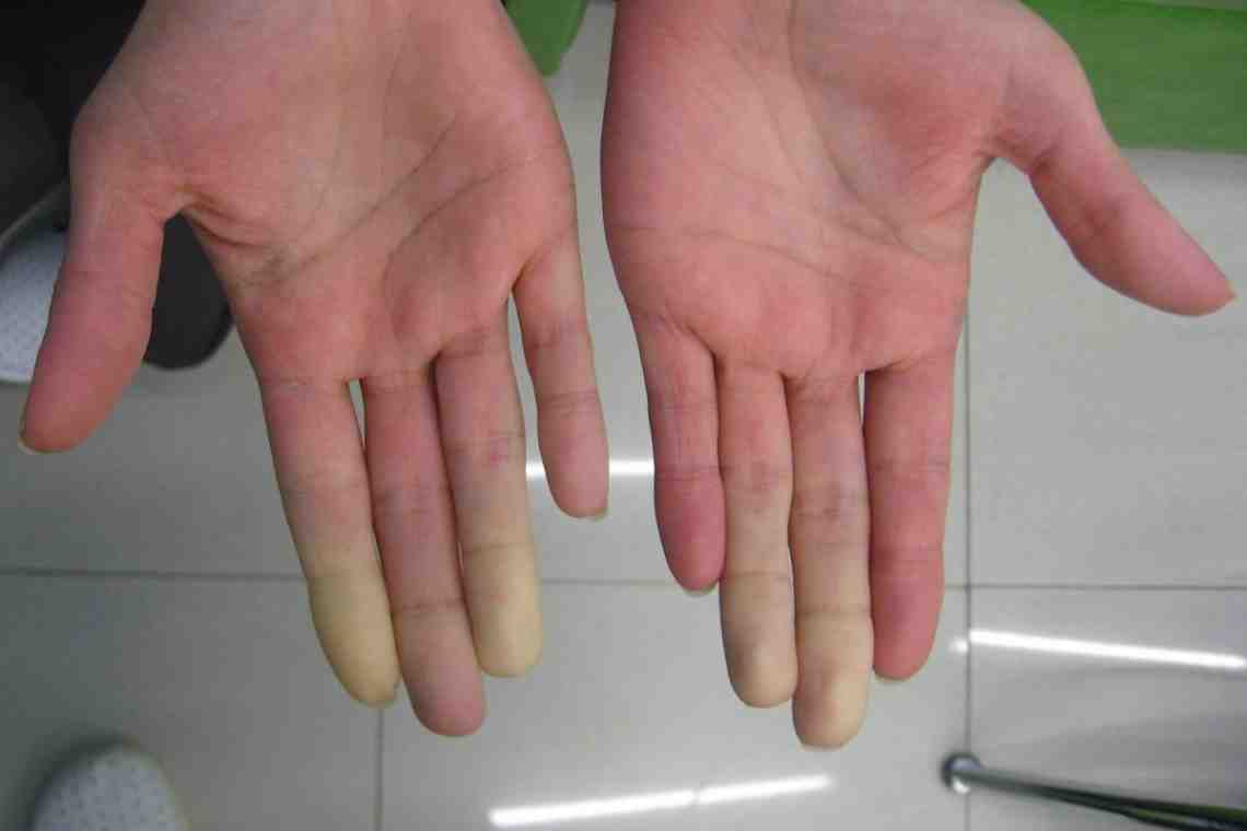 Обморожение руки: симптомы и лечение