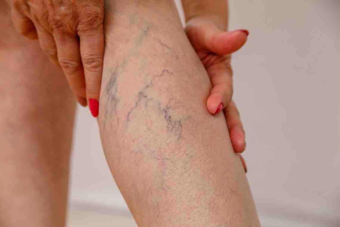 Как лечить варикоз у мужчин на ногах? Советы специалистов, народные средства