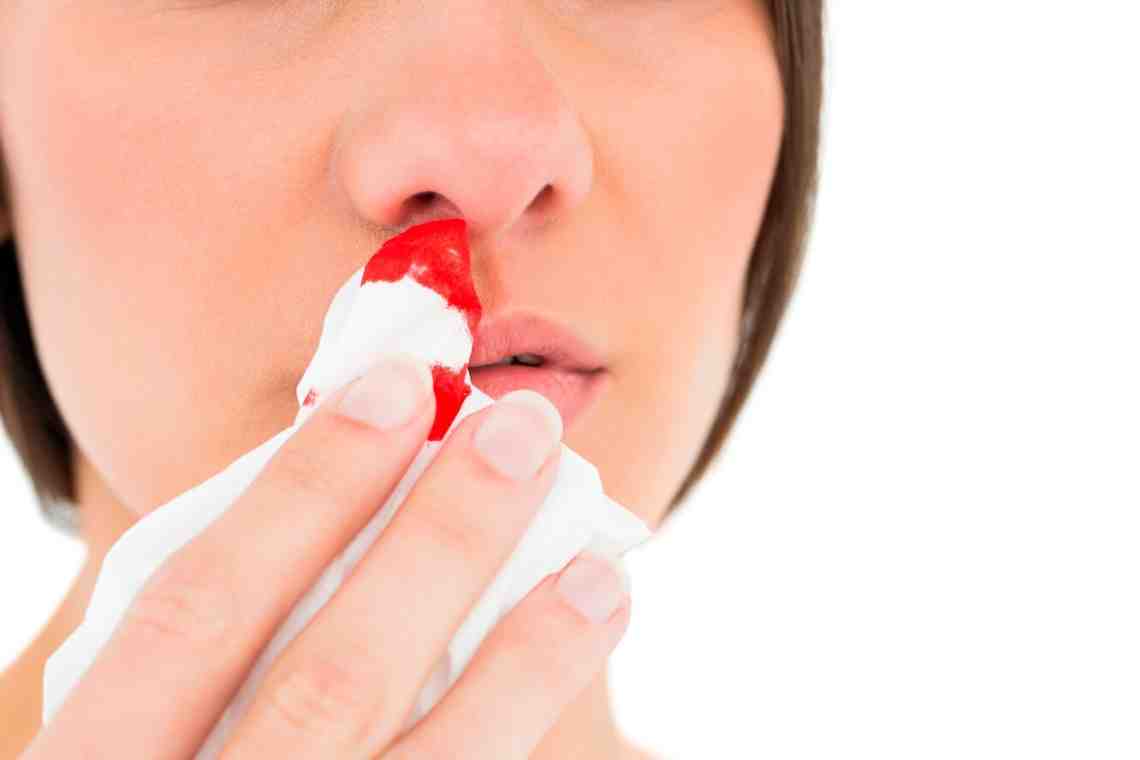 Кровотечение из носа: причины и лечение