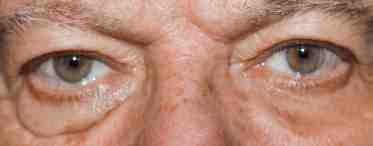 Мешки под глазами у мужчин: причина и лечение