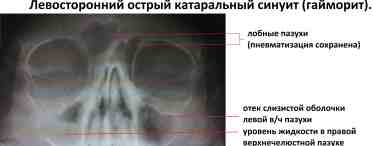 Грибковый гайморит: причины, симптомы и лечение