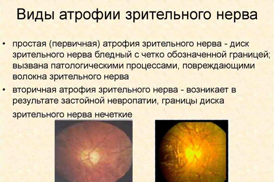 Атрофия зрительного нерва: причины, симптомы и лечение