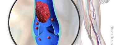 Нарушение периферического кровообращения: тромбоз и эмболия