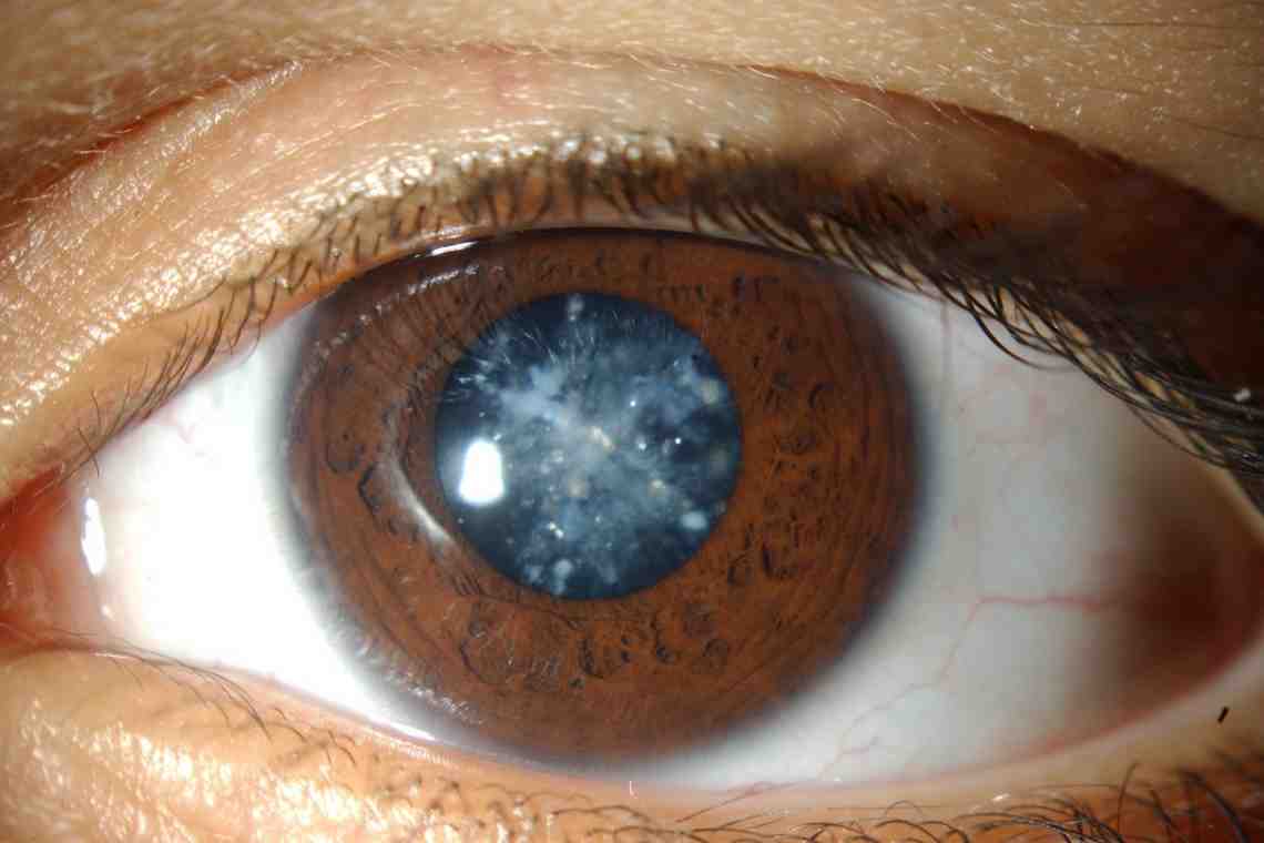 Катаракта: симптомы и лечение. Профилактика катаракты народными средствами