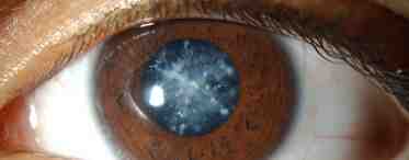 Катаракта: симптомы и лечение. Профилактика катаракты народными средствами