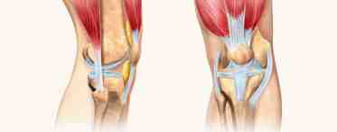 Повреждение сухожилия четырехглавой мышцы бедра