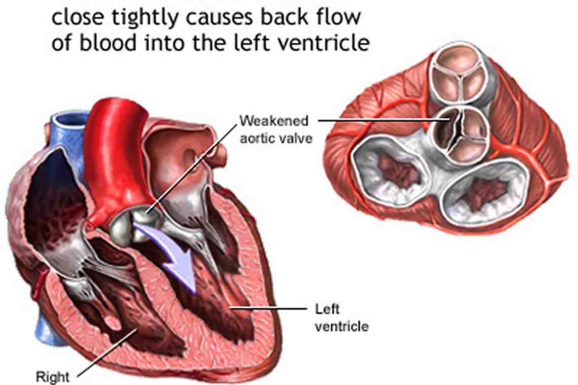 Клапан легочной артерии: норма и патологии