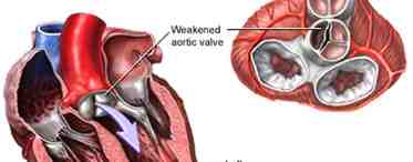 Клапан легочной артерии: норма и патологии