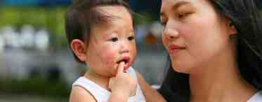 Синдром Кавасаки у детей: причины и лечение