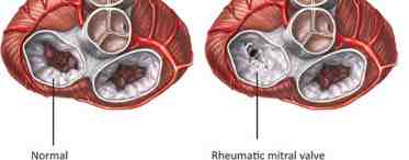 Аортальный клапан: строение, механизм работы. Стеноз и недостаточность аортального клапана
