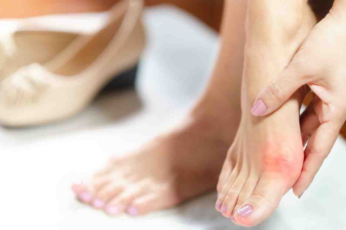 Косточки на ногах: причины и методы лечения