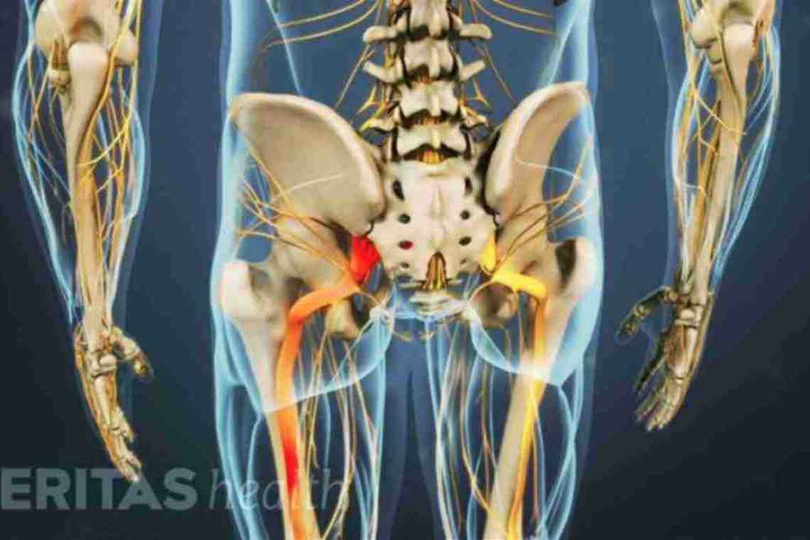 Ишиас: лечение медикаментозное и народными средствами. Ишиас: симптомы и причины возникновения