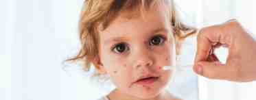 Ветряная оспа у ребенка: симптомы, формы, профилактика