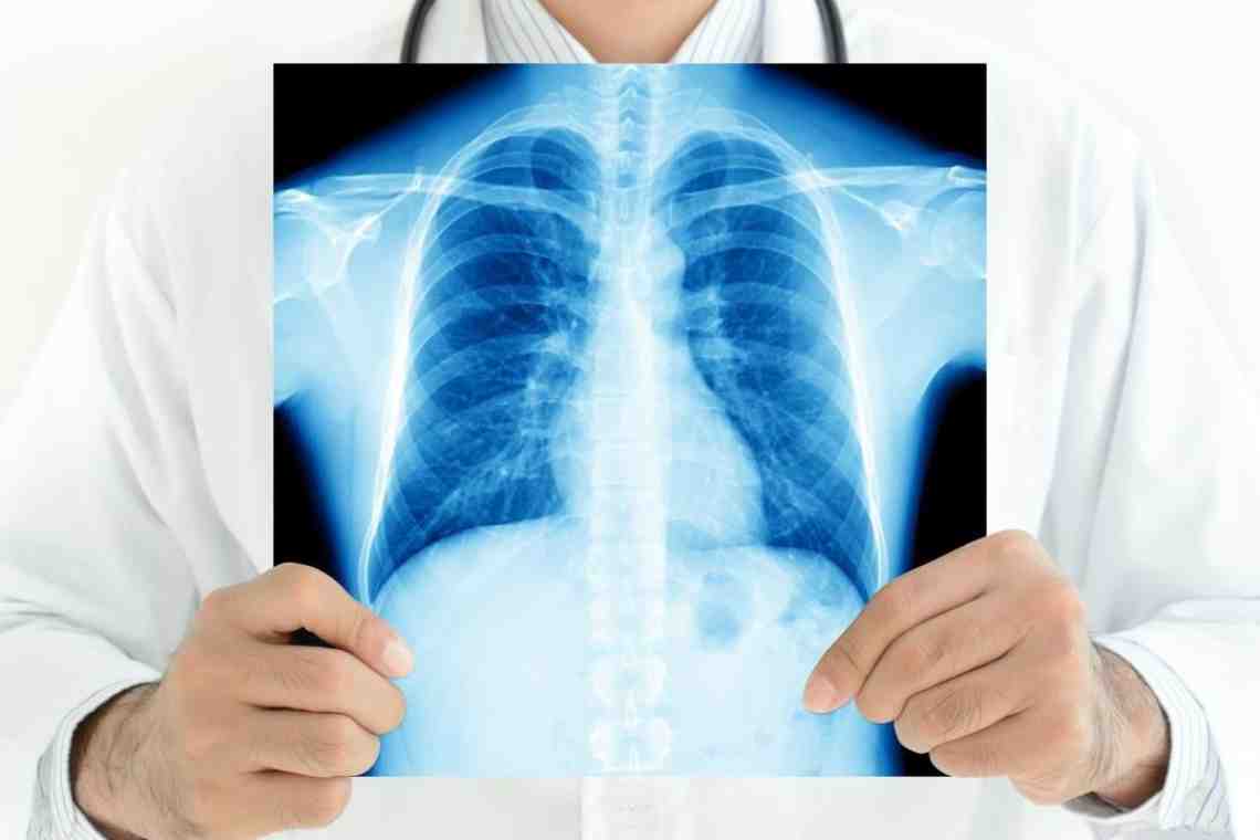 Милиарный туберкулез легких: формы, диагностика, симптомы, лечение
