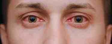 Полопались капилляры в глазу: причины, возможные заболевания, способы лечения, профилактика