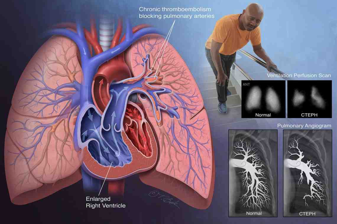 Тромбы в легких. Тромбоэмболия легочной артерии: причины, симптомы, последствия, лечение