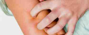 Сыпь уртикарная: причины, симптомы, диагностика и лечение