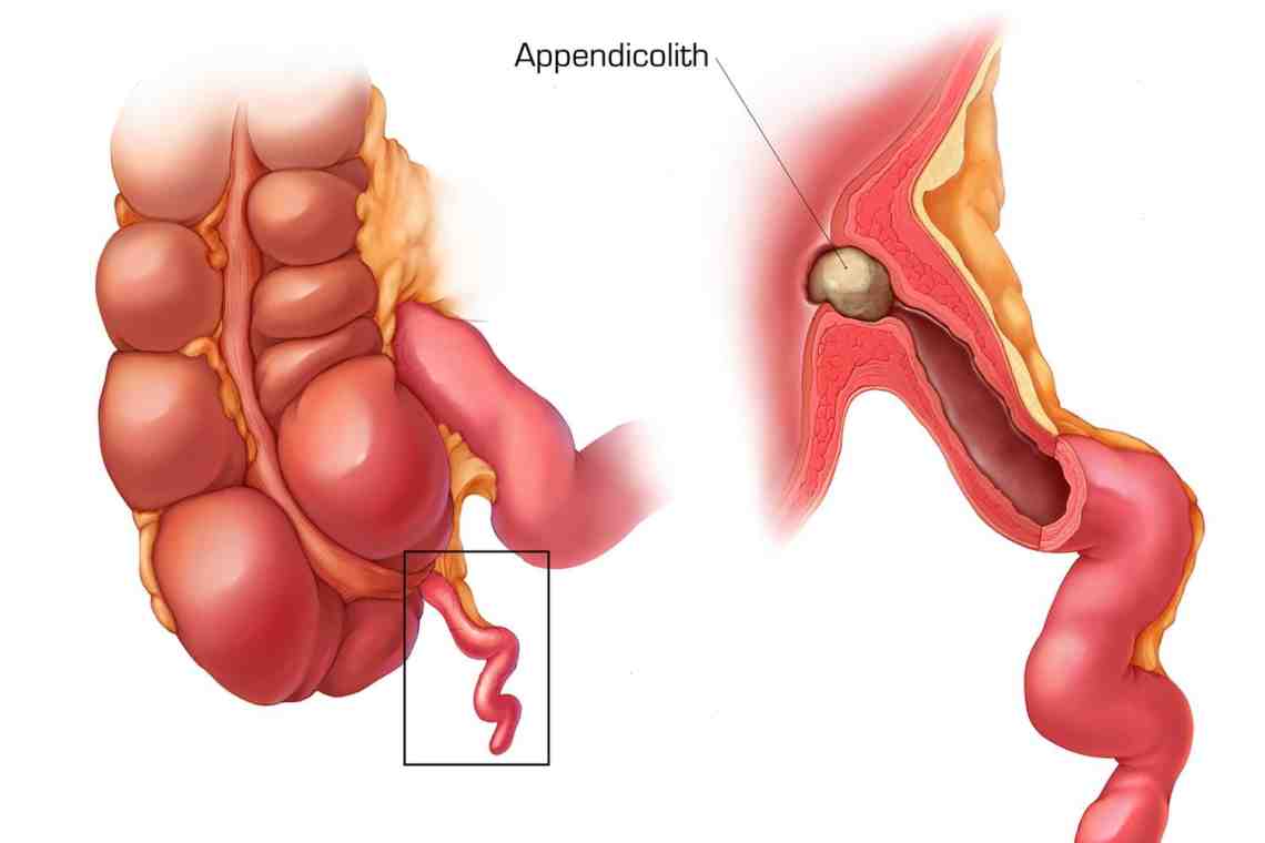 Воспаление аппендицита: описание, симптомы, причины и особенности лечения