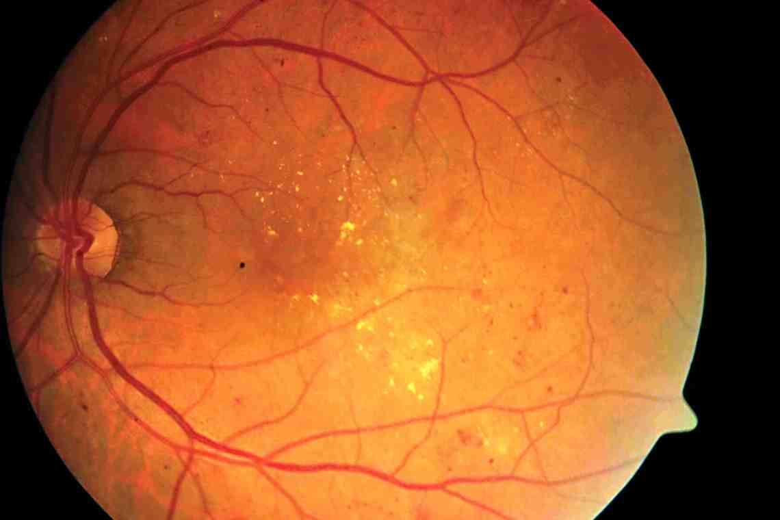 Гипертоническая ретинопатия: причины, симптомы и особенности лечения