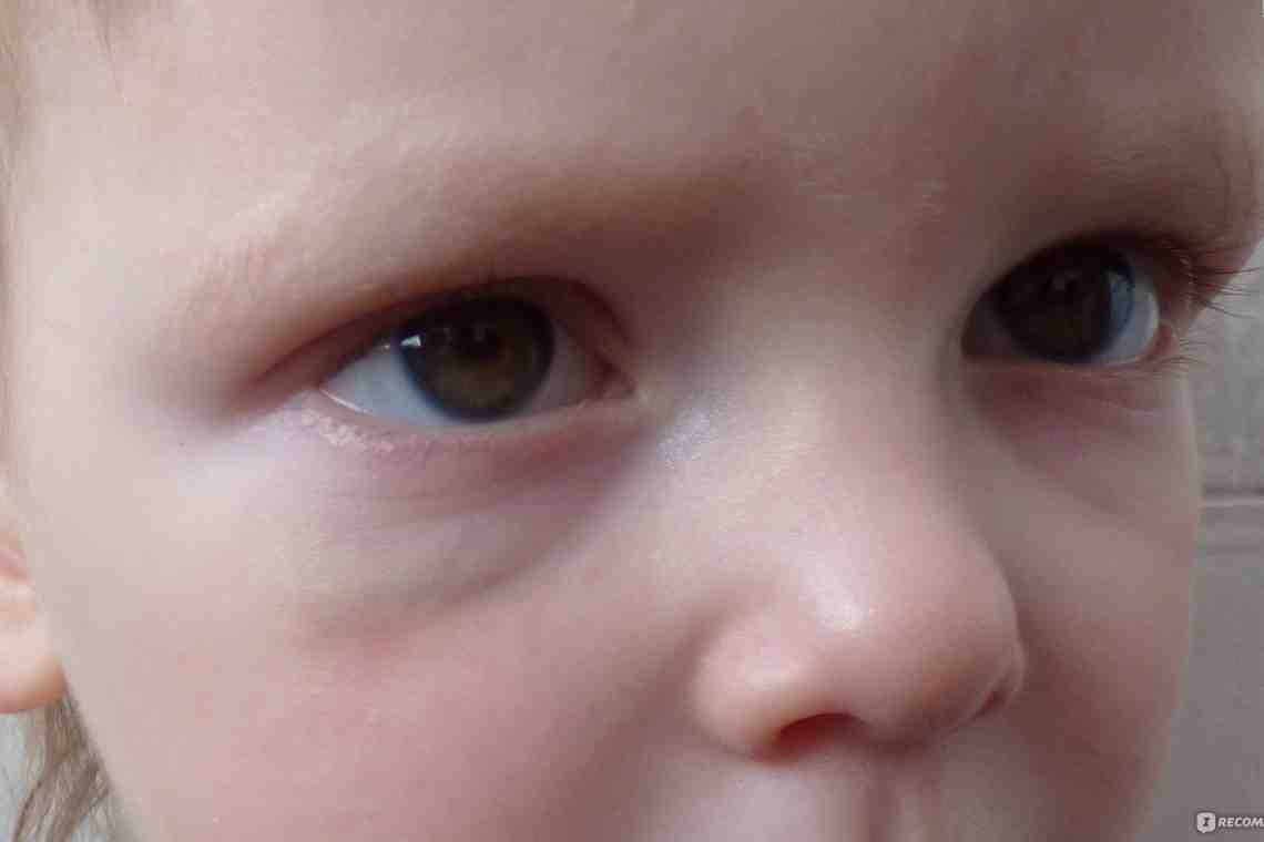 Отекло лицо у ребенка: причины появления и методы устранения отека