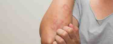 Аллергия на хлорку: симптомы и лечение
