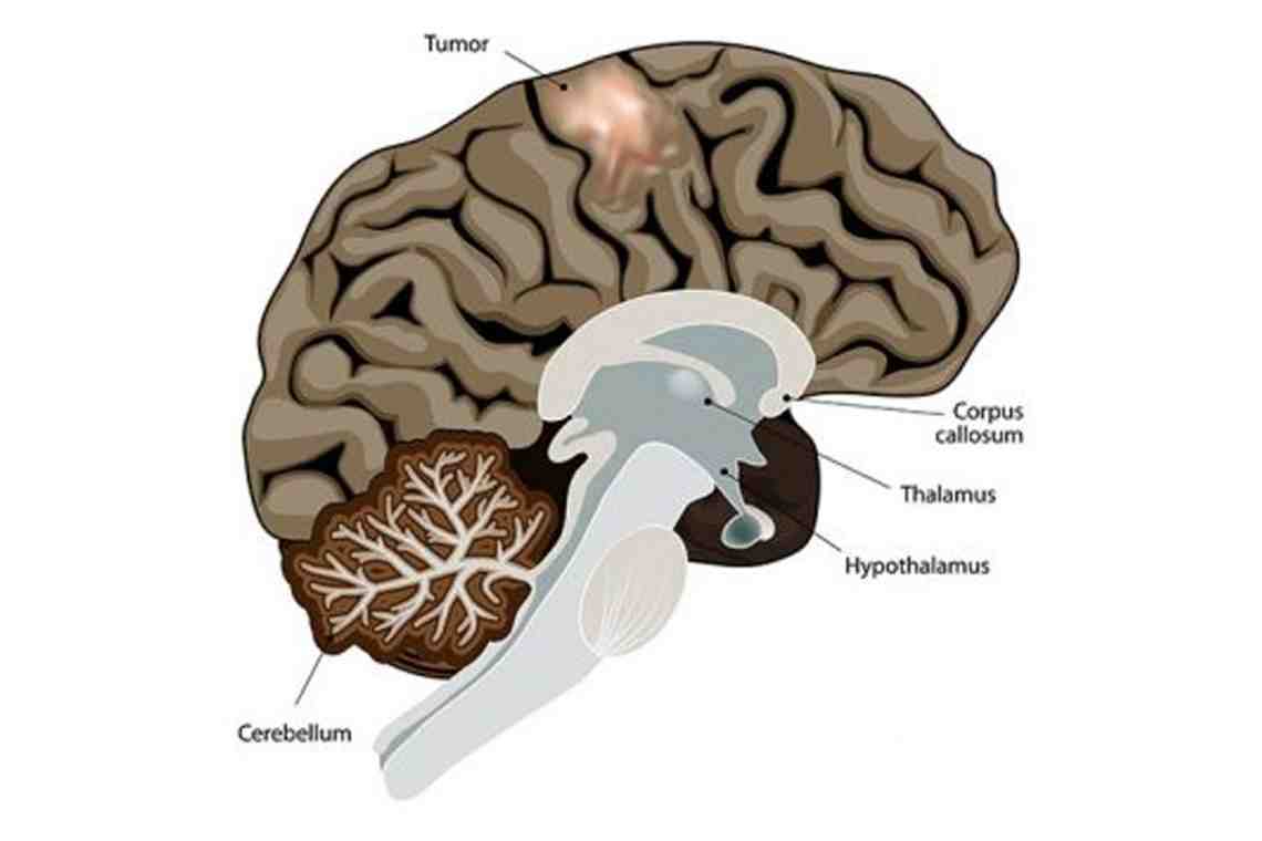Опухоль головного мозга: симптомы, стадии, лечение, операция