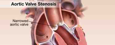 Аортальный стеноз: симптомы, лечение и последствия