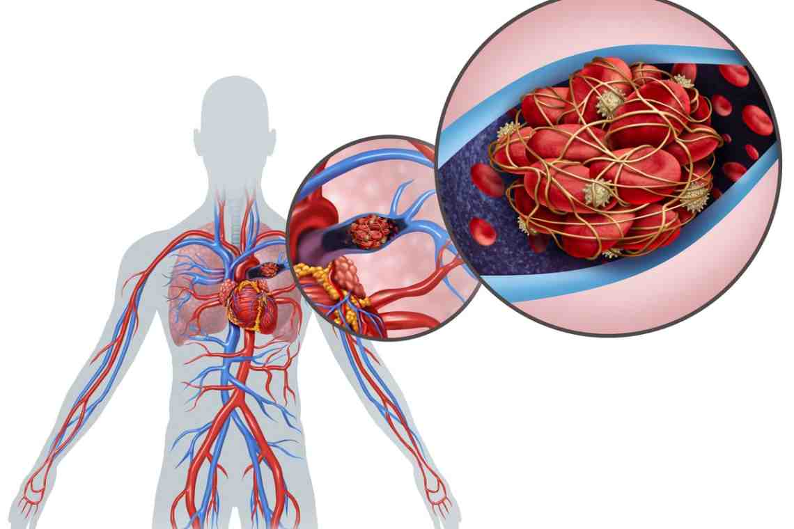 Тромбоэмболия легочной артерии: причины, диагностика, симптомы и лечение